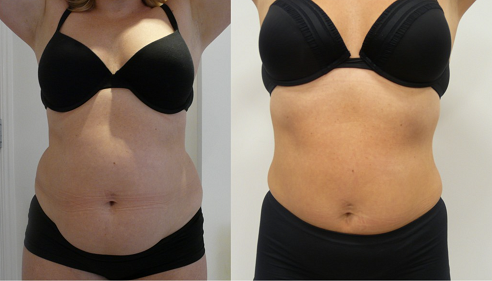 The result of using a cavitation machine to reduce fat deposits on the abdomen and sides