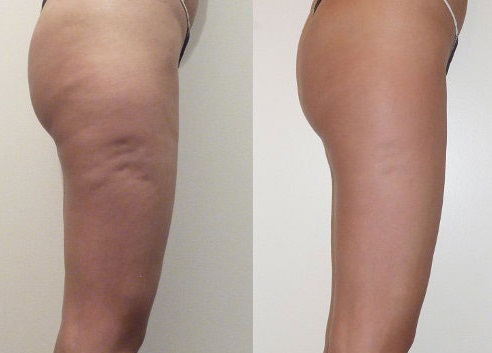 The result of using a cavitation machine for the treatment of cellulite