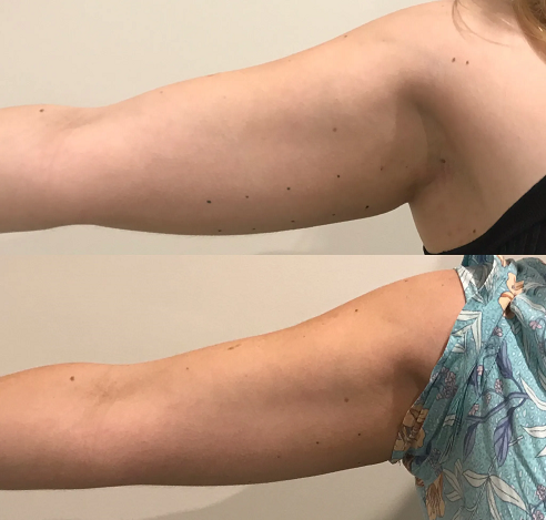 The result of using a cavitation machine to reduce fat deposits on the arms