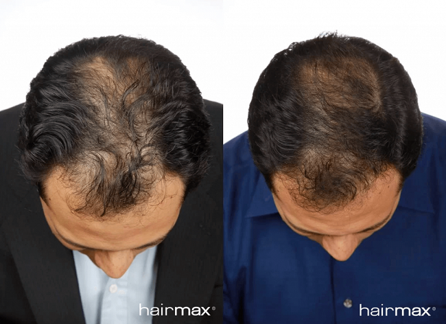 Is Hairmax Laser Comb Worth The Investment? In-Depth Review - Dr. Jose ...