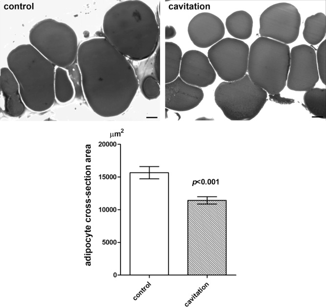 lipid vacuoles reduction