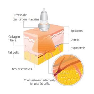 What Is a Cavitation Machine: Effectiveness + Before & After - Doctor Mier