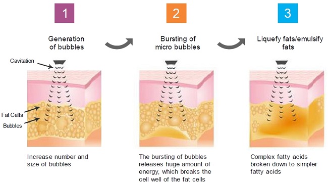 ultrasound-cavitation-process