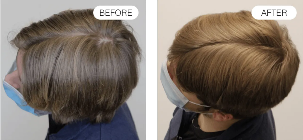 Before and after using red light therapy for hair loss (12 months)