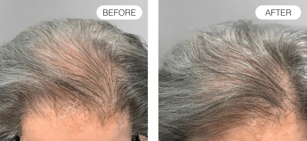 Before and after using red light therapy for hair loss (12 months)
