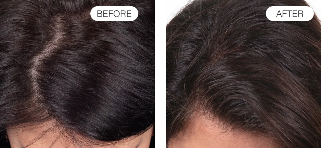 Before and after using red light therapy for hair loss (10 months)
