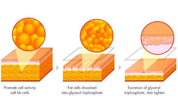Breakdown of fat cells due to ultrasonic cavitation