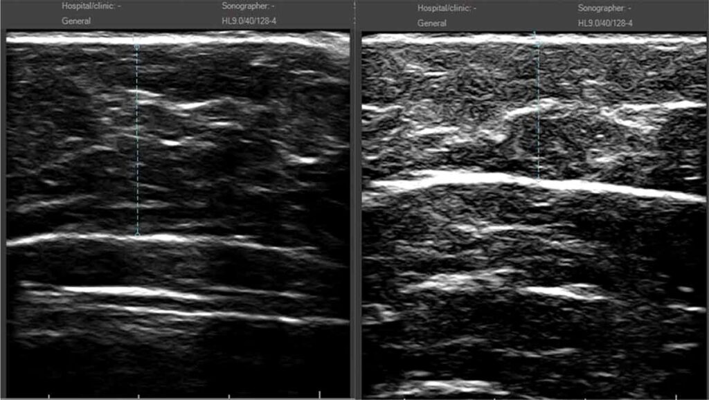 Ultrasound image of the patient before and after cavitation treatment: measurement showed 7.0 mm reduction (from 21.2 mm at baseline to 14.2 mm at follow-up)