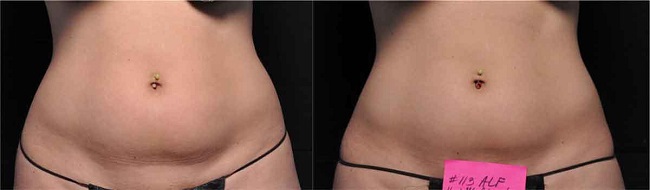 The result of three sessions of cavitation treatment on the abdomen