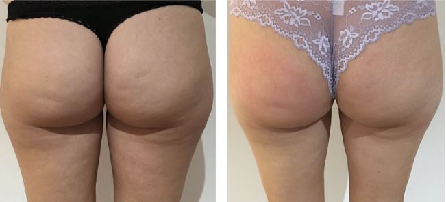 The result of treatment with a cavitation machine for the buttocks