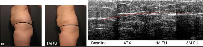 Results of four fat reduction procedures at 1 and 3 months (photo and ultrasound)