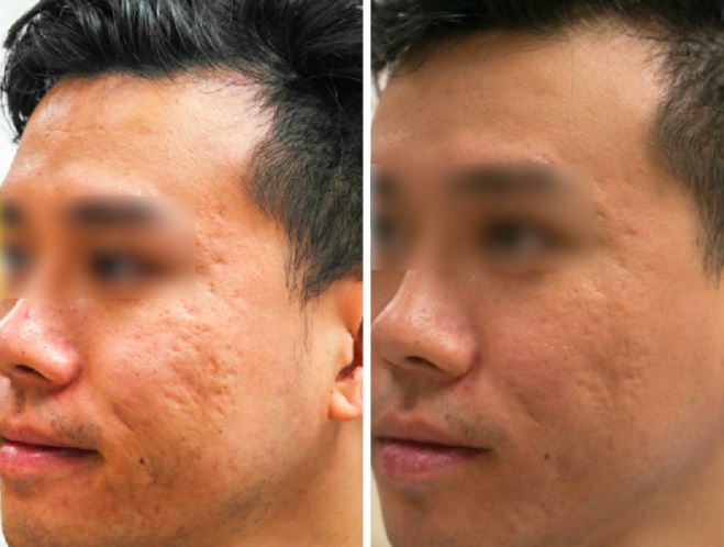 Result of using cold laser therapy for acne treatment