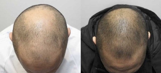 The result of using red light therapy for the treatment of hair loss (16 weeks)
