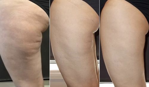 The result of treatment with a cavitation apparatus for the sides and thighs