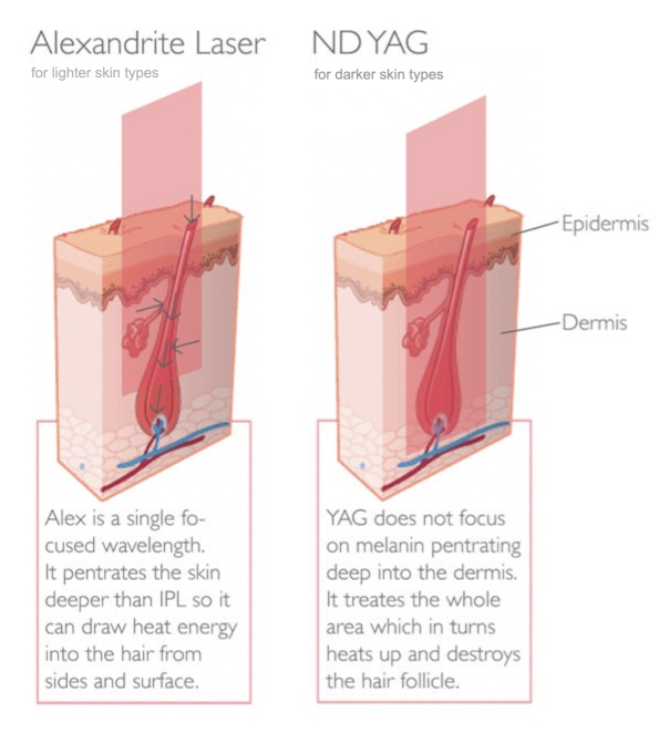 Comparison between Alexandrite laser and Nd: YAG