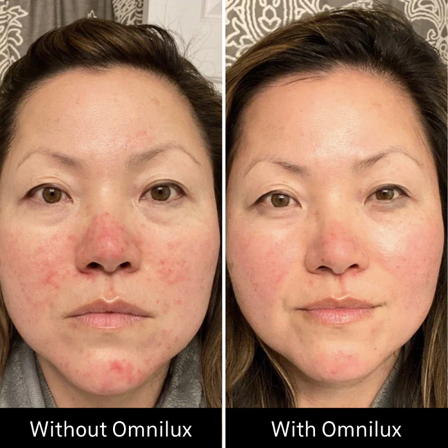 Before & After Omnilux Contour Face in 6 weeks