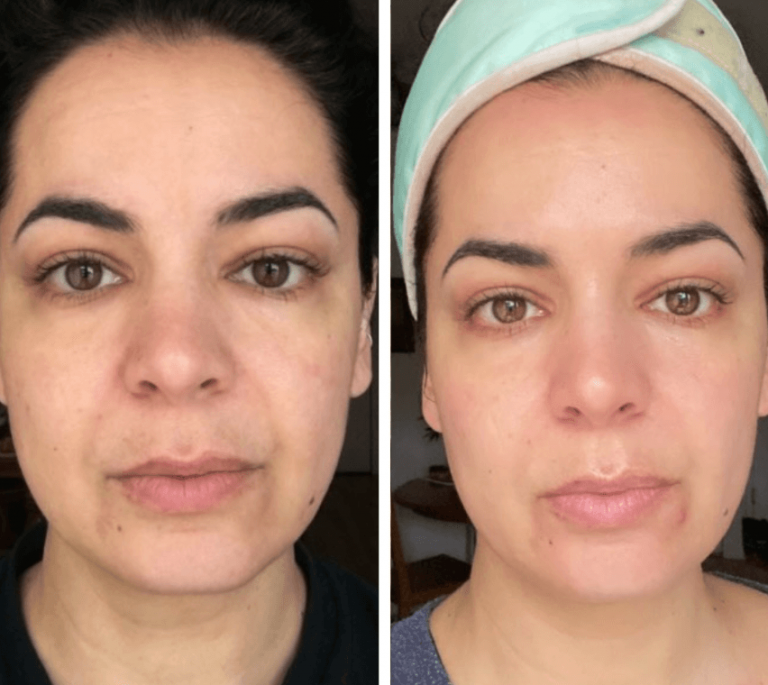 Results After Using Omnilux Contour Face for 2 Months