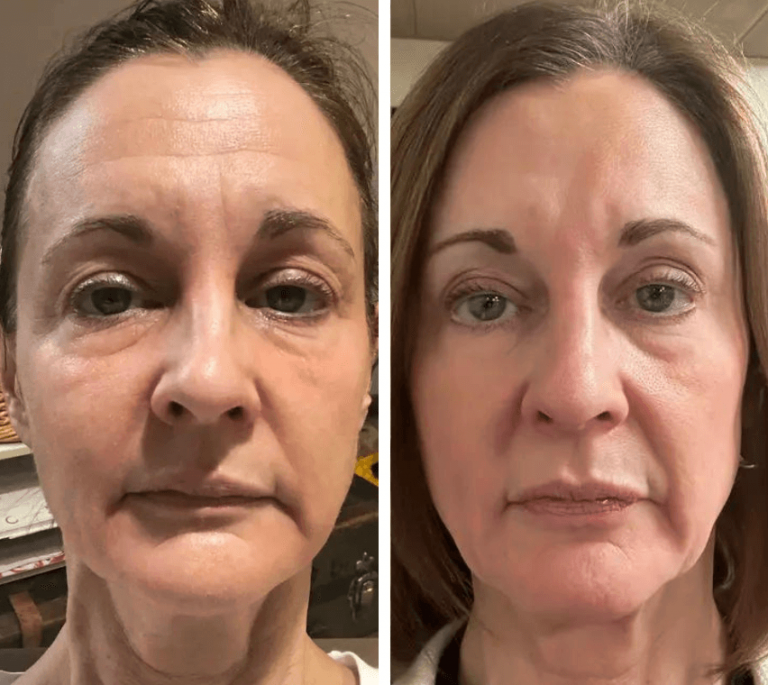 Results After Using Omnilux Contour Face for 3 Months