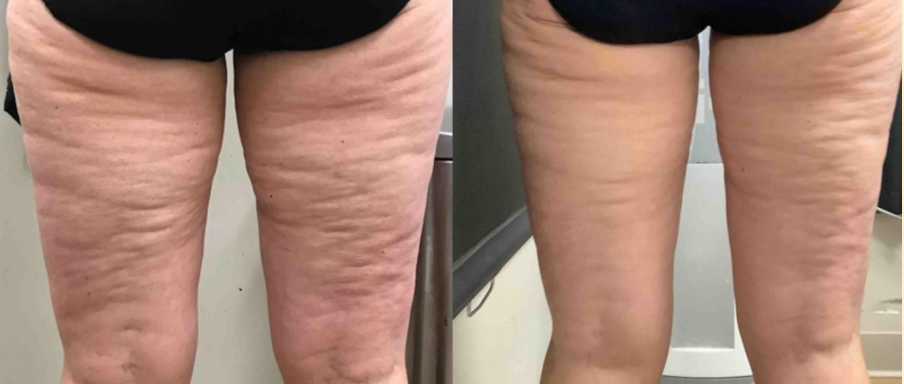 Laser Skin Tightening Before And After