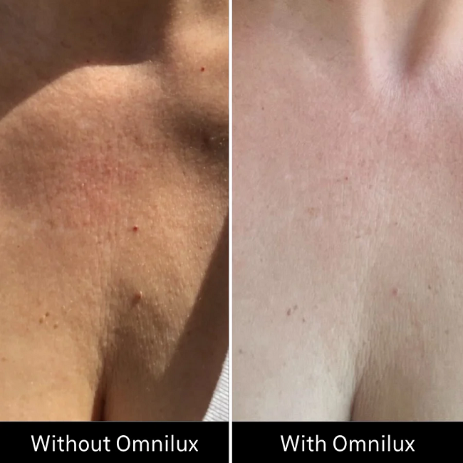 Before & After Omnilux Contour Neck & Décolleté in 3 weeks