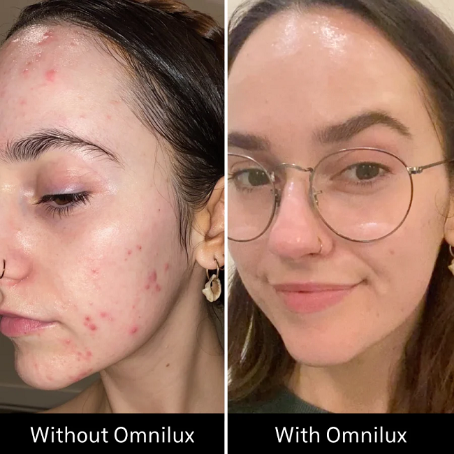 Before & After Omnilux Clear in 3 months