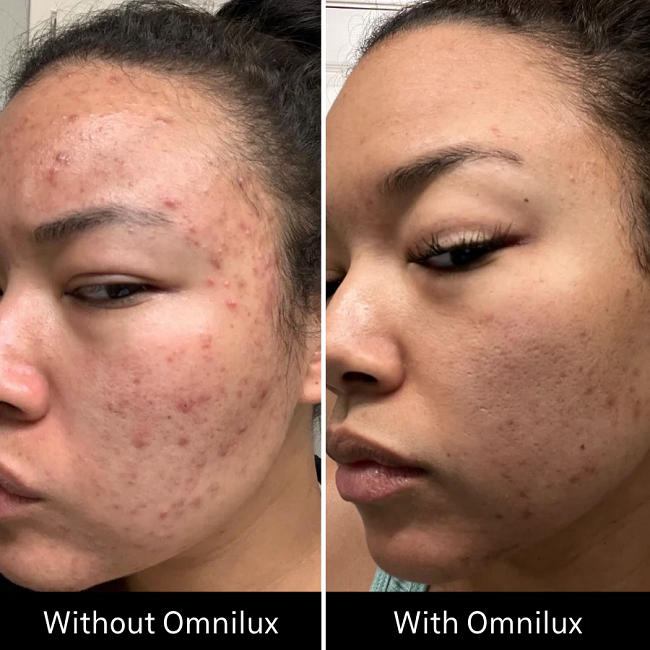 Omnilux Clear in 1 month