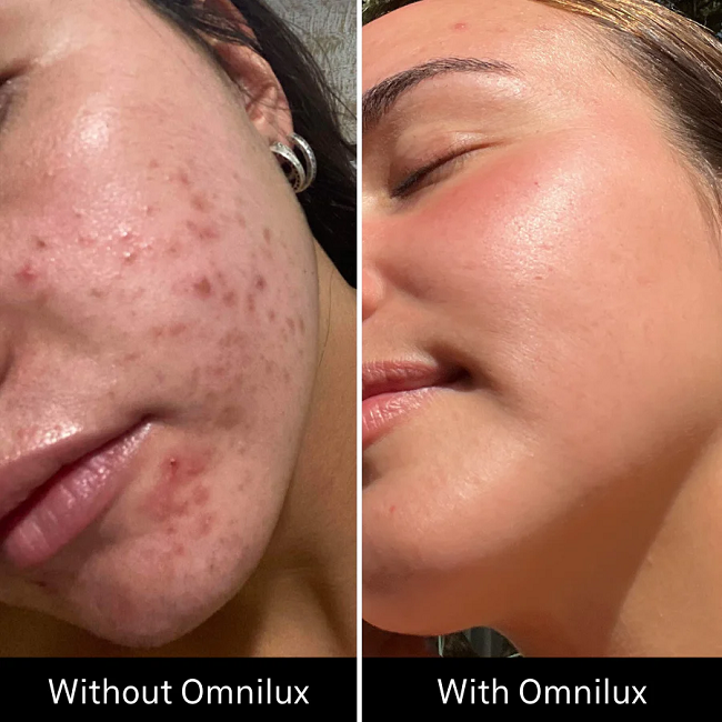Before & After Omnilux Clear in 3 months