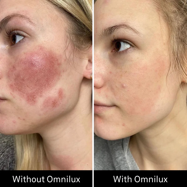 Before & After Omnilux Contour Face in 2 months