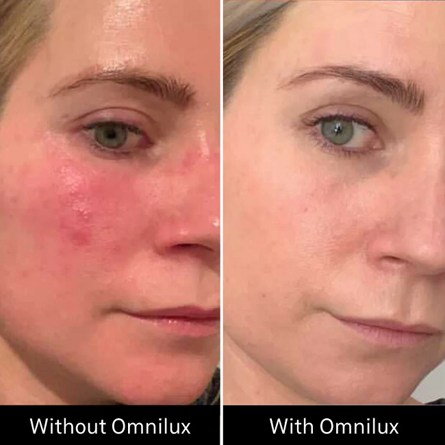 Before & After Omnilux Contour Face in 7 weeks