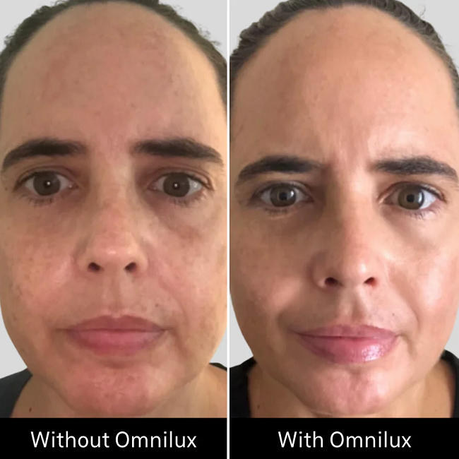 Before & After Omnilux Contour Face in 8 weeks