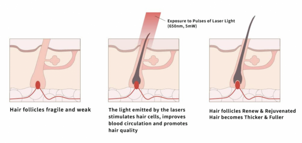 Red light therapy for hair loss: working principle
