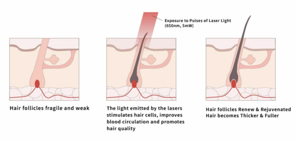 Hair Loss: There's a (Red) Light at the End of the Tunnel