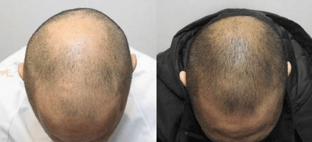 The result of using red light therapy for hair loss treatment (24 weeks)