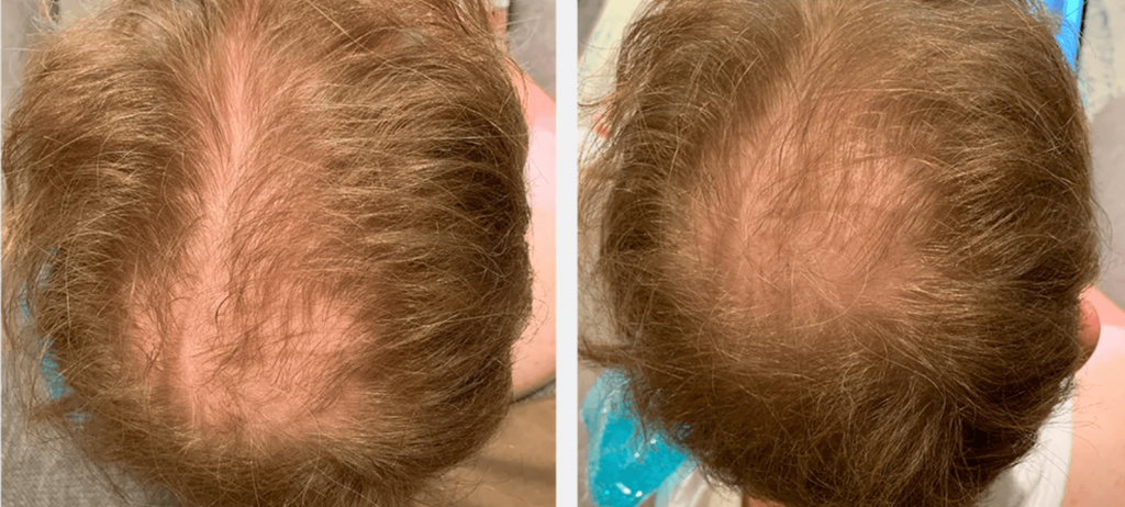 Red Light Therapy for Hair Loss: Does it Really Work?