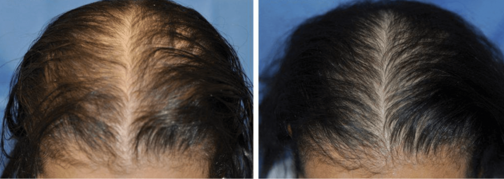 The result of using red light therapy for hair loss treatment (26 weeks)