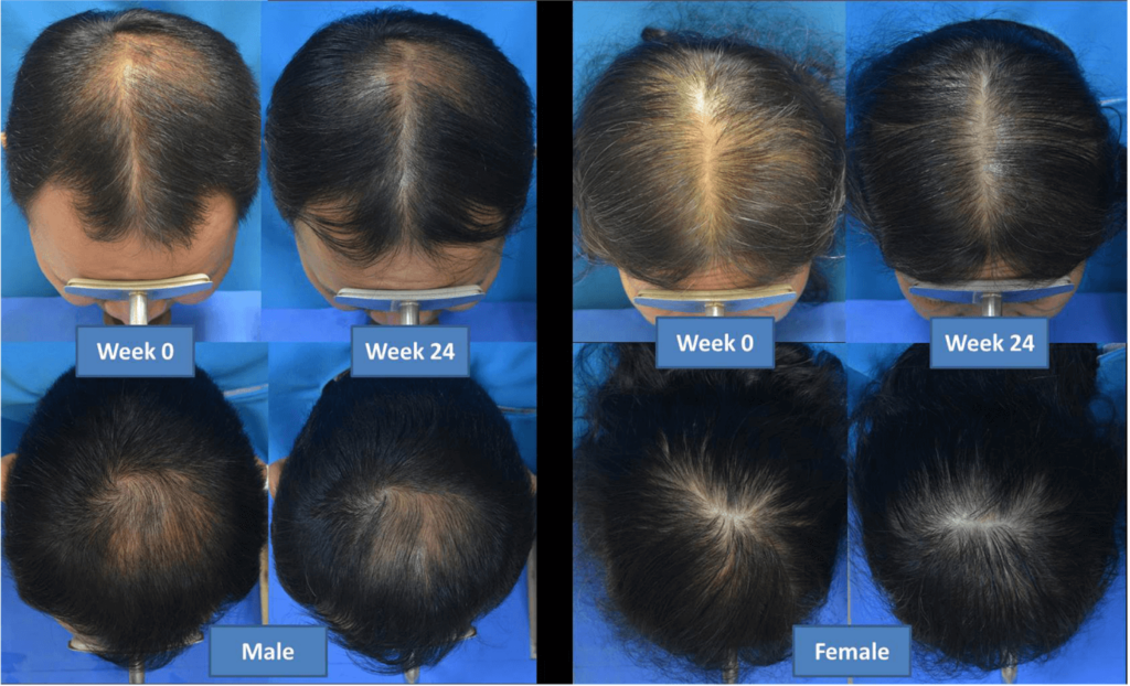 Baseline and week 24 results of laser helmet-treated patients