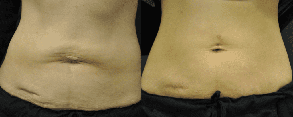 The result of using Exilis skin tightening 