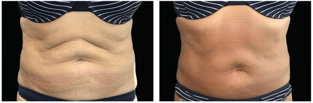 The result of using Exilis skin tightening 