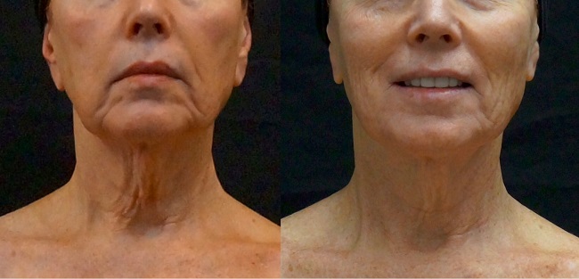 The result of using Exilis skin tightening 