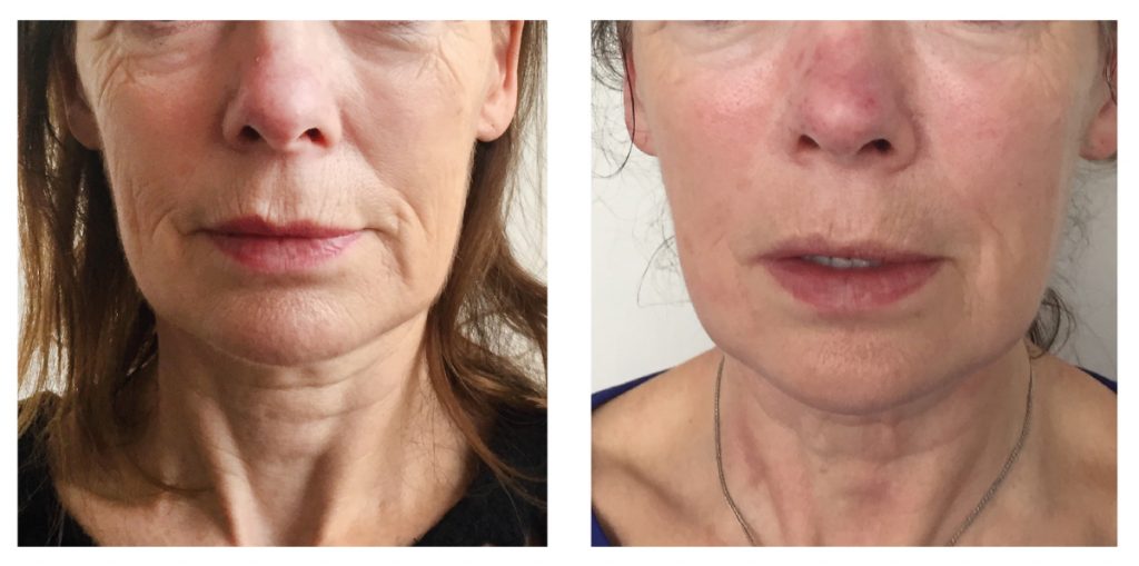 Exilis Ultra Skin Tightening Before & After Photos Patient 34