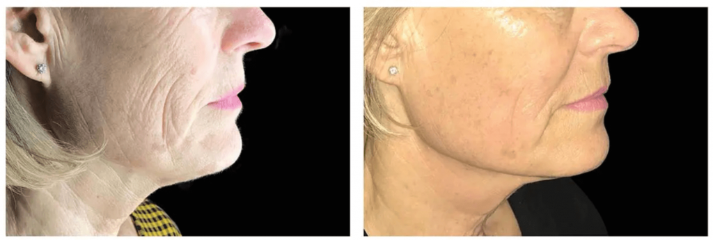 The result of using Exilis skin tightening 