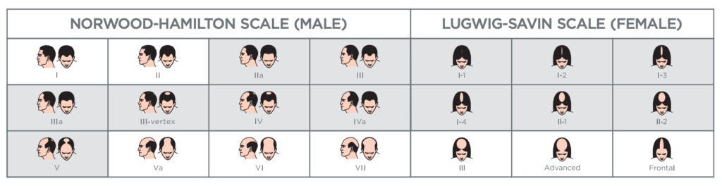 Types of hair loss for which iRestore Professional will be effective (colored in gray)
