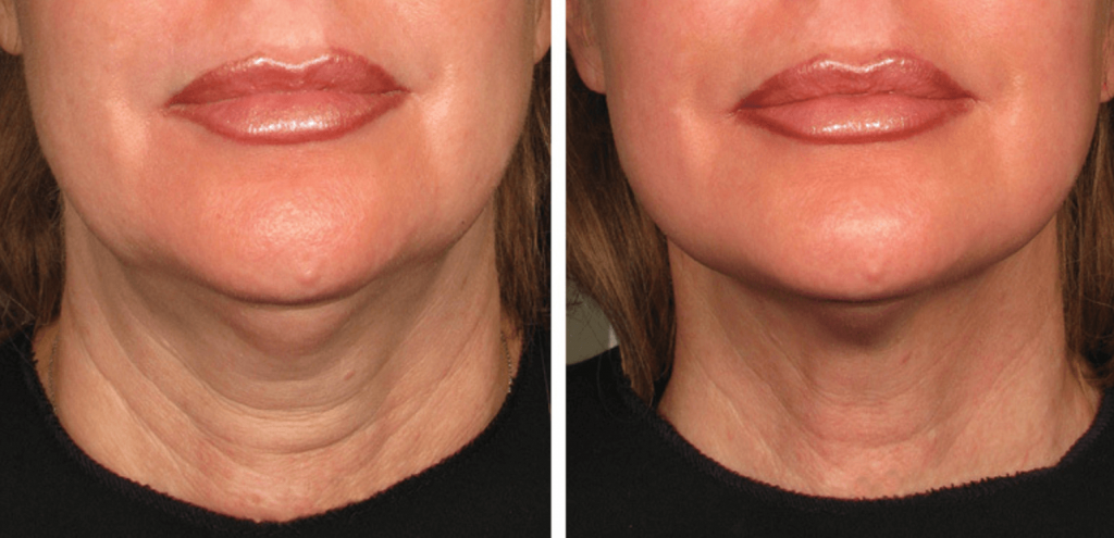 How Does Surgery-Free Skin Tightening Work? - Radiance Skincare & Laser  Medspa - Wheaton, IL