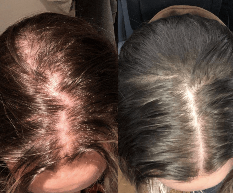 The result of using a laser cap to eliminate alopecia