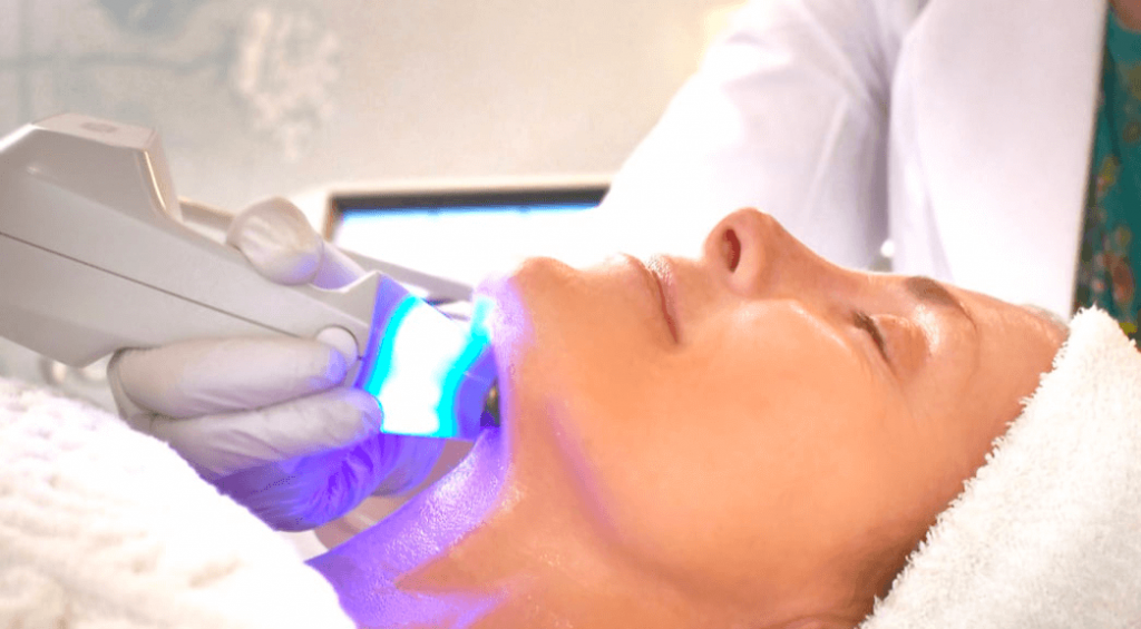 Exilis skin tightening