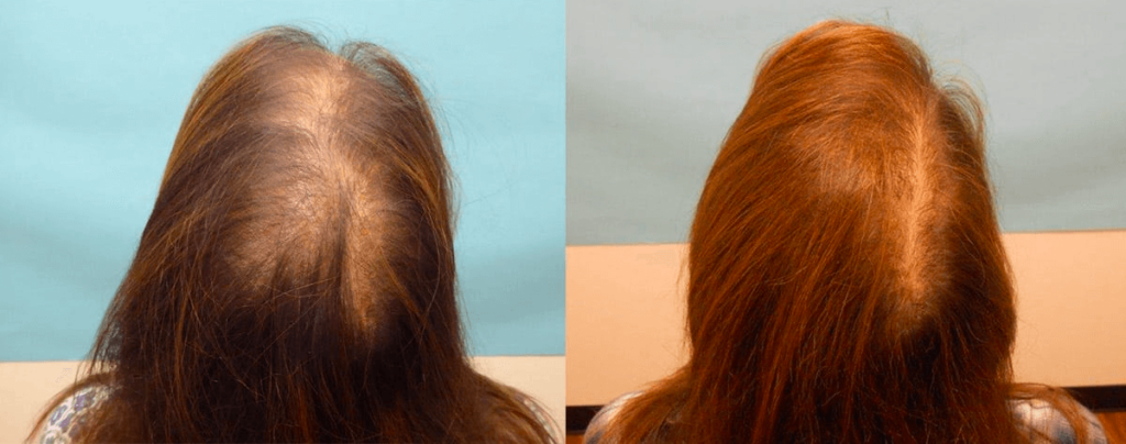The result of using red light therapy for hair loss treatment (18 weeks)