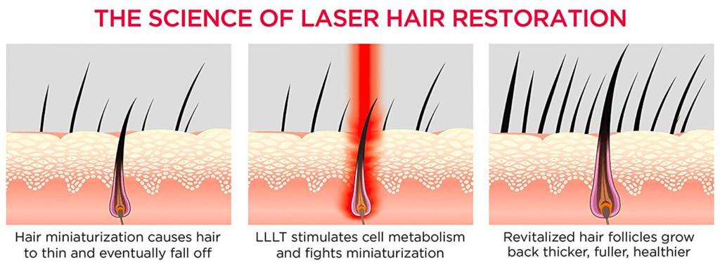laser hair restoration