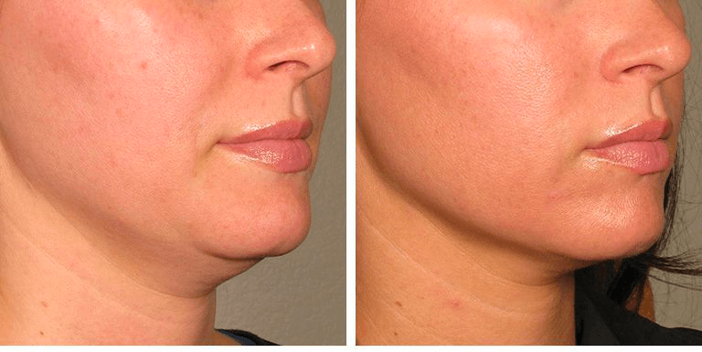 The result of using laser skin tightening (1 session)