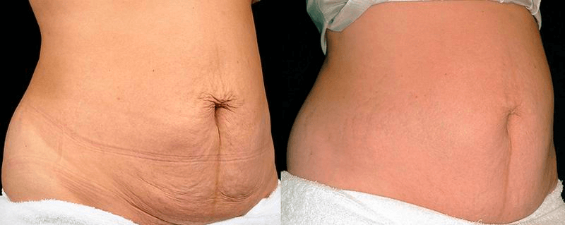 Laser Skin Tightening Before And After: In-Depth Guide - Doctor Mier