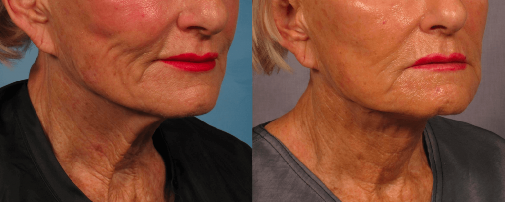 The result of using laser skin tightening (3 sessions)